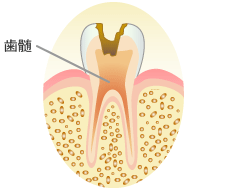 歯髄（歯の神経）の虫歯