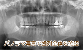 パノラマ写真で全顎の歯周病感染状態を確認