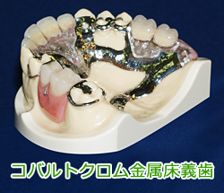 金属床義歯 ： キャストプレート