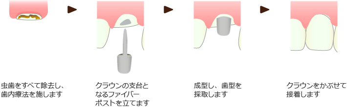 クラウン修復法の治療イメージ