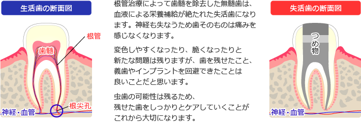 失活歯と生活歯の違い