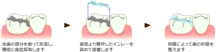 インレー修復法の治療イメージ