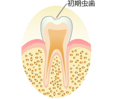 初期の虫歯