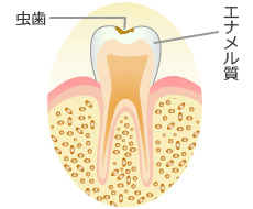 エナメル質の虫歯