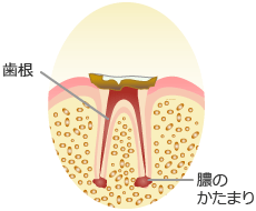 歯冠崩壊した末期の虫歯