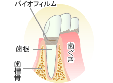 歯肉炎