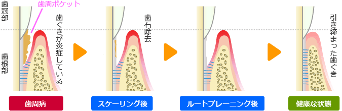 ルートプレーニング（歯根面クリーニング）