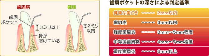 歯周ポケットの深度測定