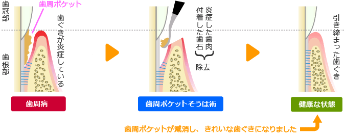 歯周ポケット掻爬(そうは)術