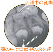 “活躍中の乳歯”と“顎の中で準備中の永久歯”のレントゲン写真