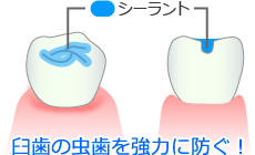 フッ化物歯面塗布法：フッ素パワーで虫歯予防