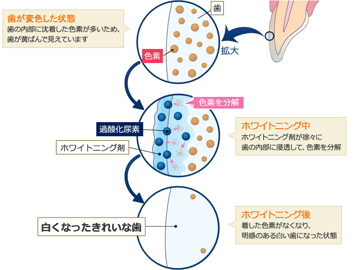 ティオン・ホームホワイトニングの歯が白くなるメカニズム