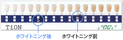 ティオン・ホームホワイトニングならシェードガイドで歯の白さを見比べながら、ホワイトニングをお楽しめます。