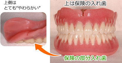 ソフトデンチャー・シリコーン義歯